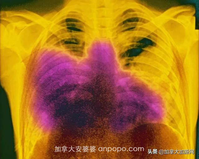 大温爆发新非典型肺炎 死亡率是新冠15倍 多人确诊